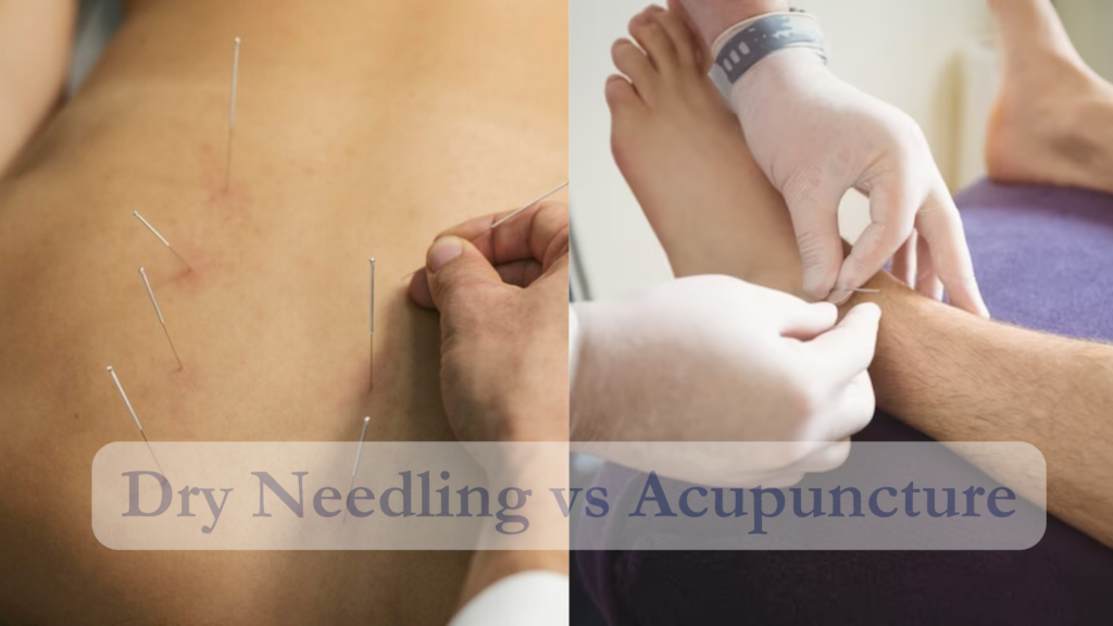 Dry Needling vs Acupuncture